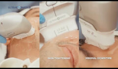MOLD Manila Shares the Spotlight on Ultraformer Deep Dive (1)